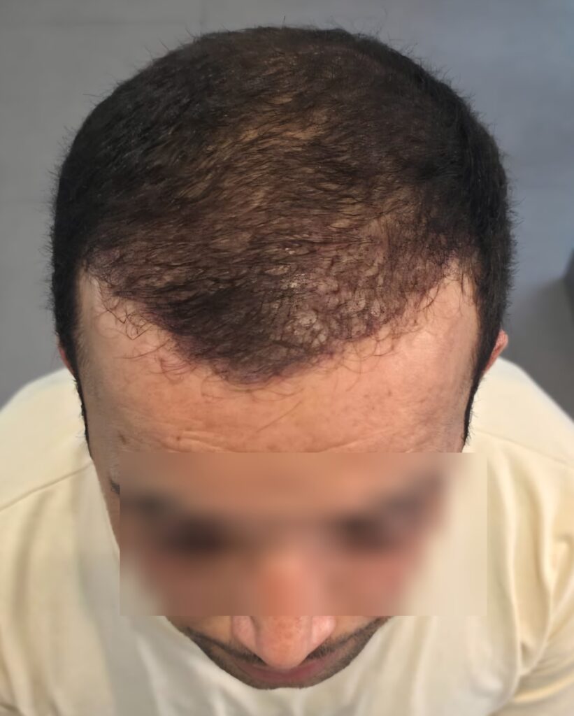 Hammouda — résultat après Long Hair FUE — face