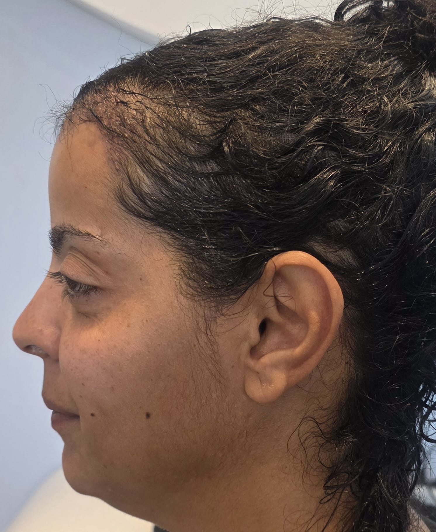 M., à J1 après Long Hair FUE (1500 greffons) — profil