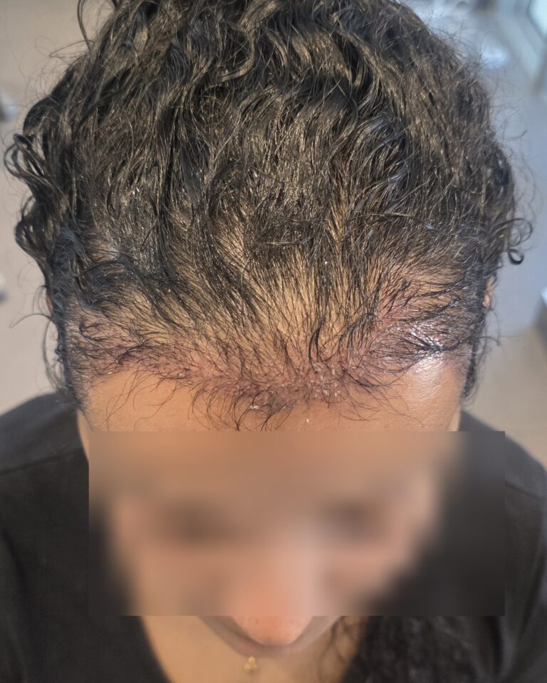 M., à J1 après Long Hair FUE (1500 greffons) — face