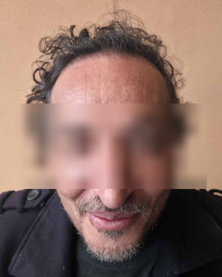 Y., à 12 mois après greffe FUE (1600 greffons) — face