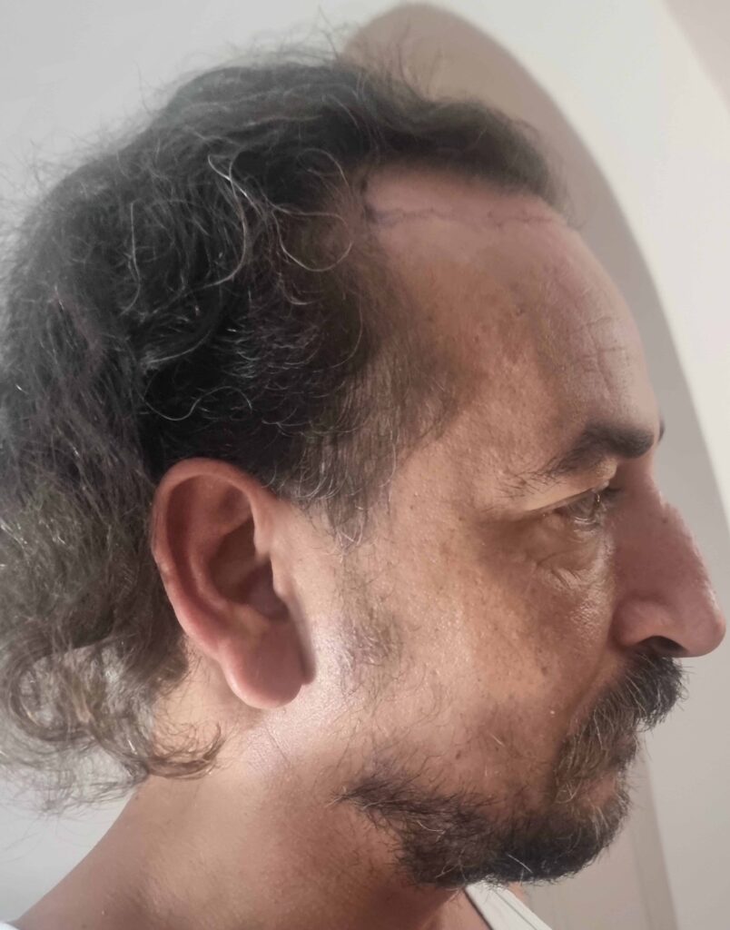 Yanis — avant intervention — profil